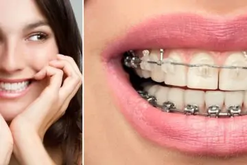 How to Get Braces Glue Off Your Teeth