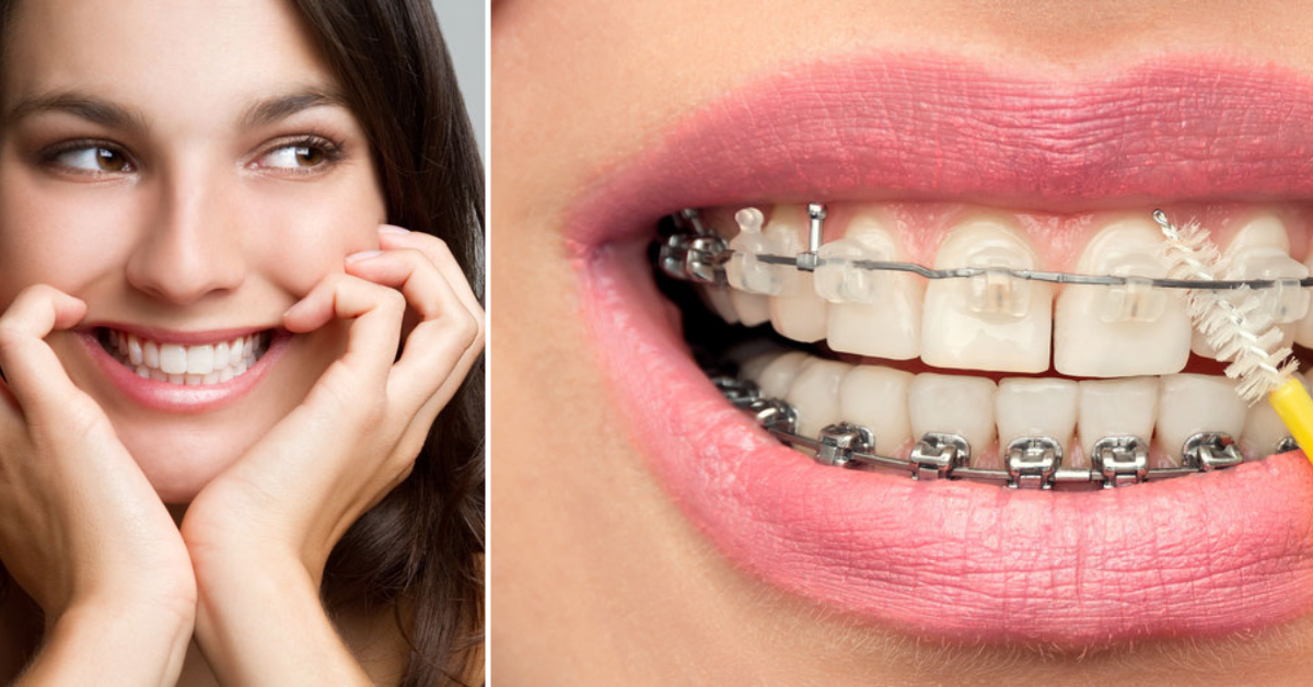 How to Get Braces Glue Off Your Teeth