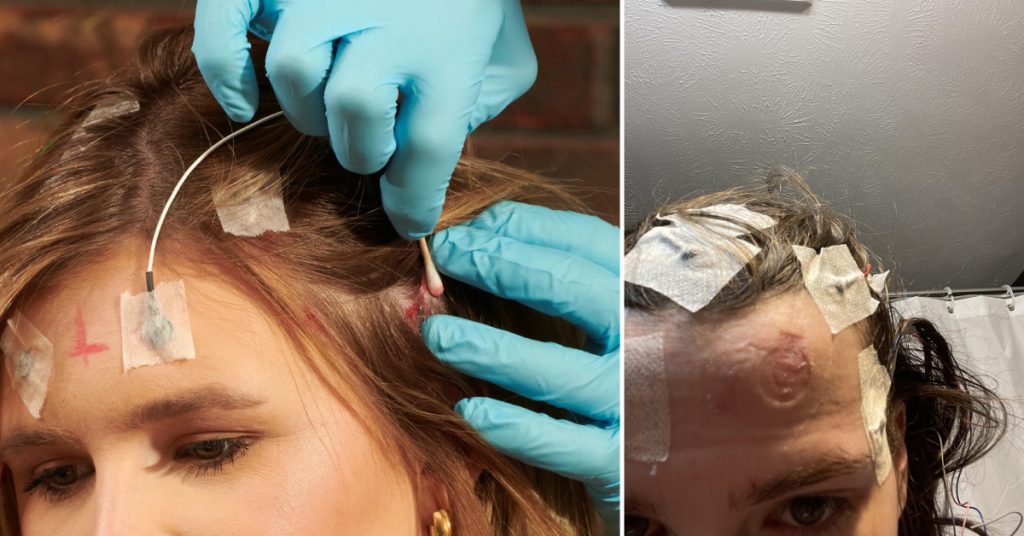 How to Remove EEG Glue From Hair